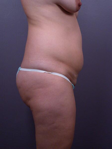 Liposuction Before & After Image