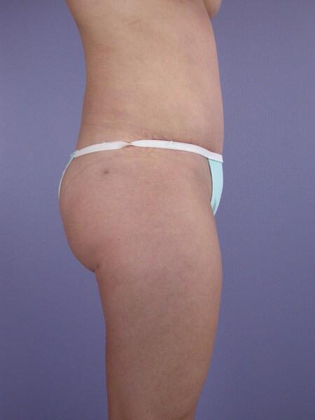 Liposuction Before & After Image