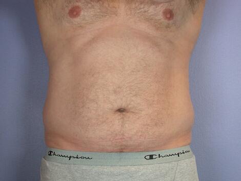 Liposuction Before & After Image