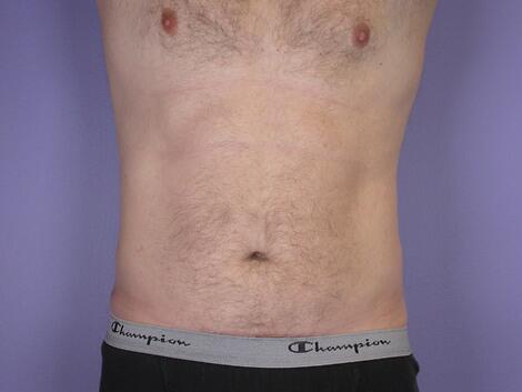 Liposuction Before & After Image