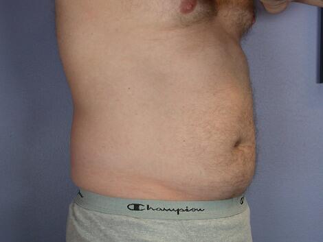 Liposuction Before & After Image