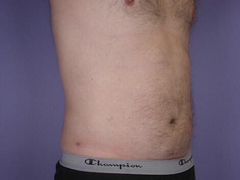 Liposuction Before & After Image