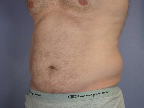 Liposuction Before & After Image