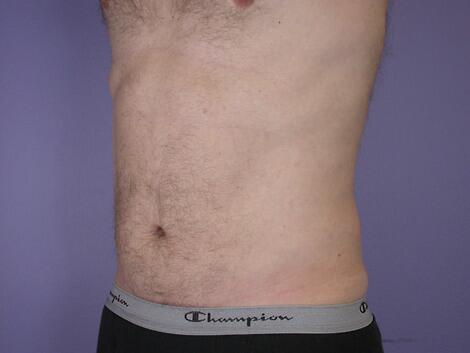 Liposuction Before & After Image