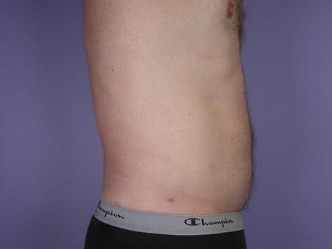 Liposuction Before & After Image