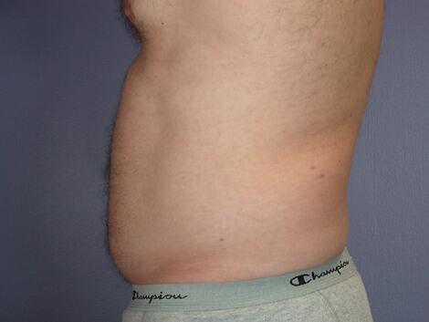 Liposuction Before & After Image