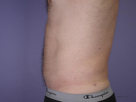 Liposuction Before & After Image