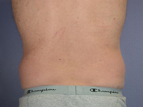 Liposuction Before & After Image