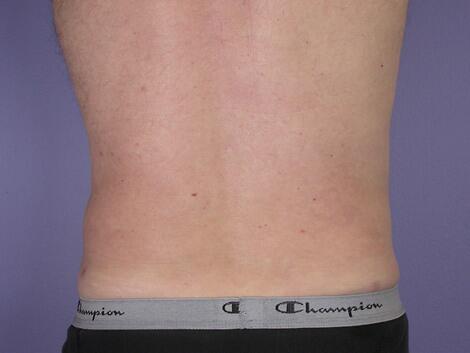 Liposuction Before & After Image