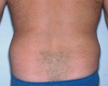 Liposuction Before & After Image