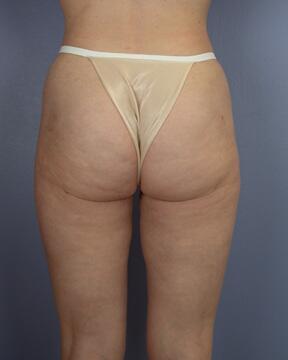 Liposuction Before & After Image