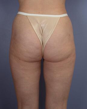 Liposuction Before & After Image