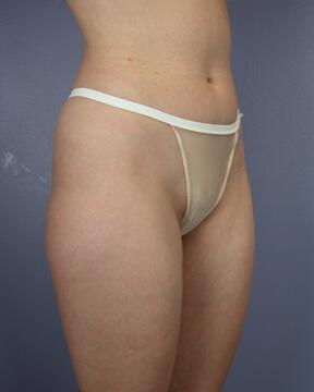 Liposuction Before & After Image