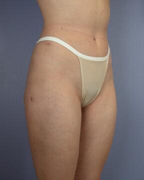 Liposuction Before & After Image