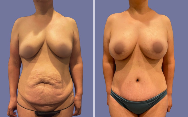 Mommy Makeover Before & After Image