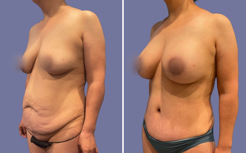 Mommy Makeover Before & After Image