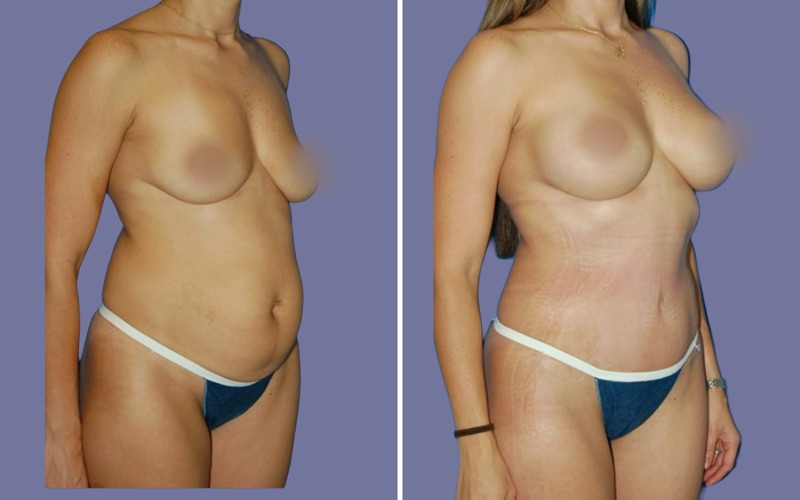 Mommy Makeover Before & After Image