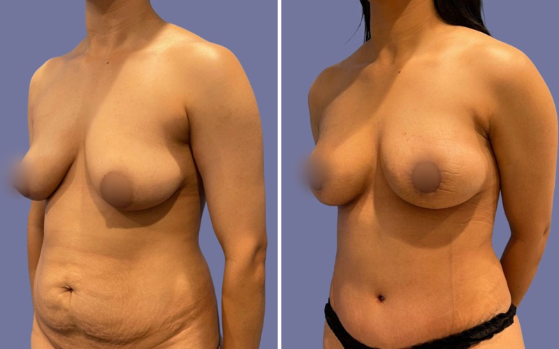 Mommy Makeover Before & After Image