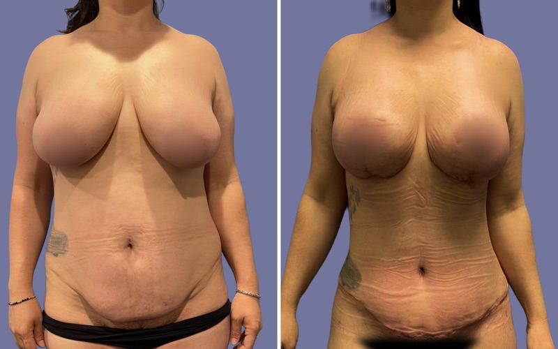 Mommy Makeover Before & After Image
