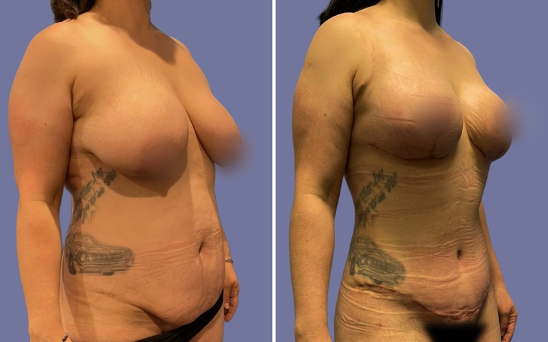 Mommy Makeover Before & After Image