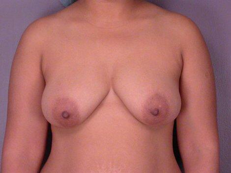 Mommy Makeover Before & After Image
