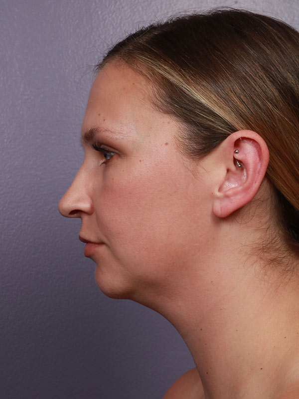 Neck Lift Before & After Image