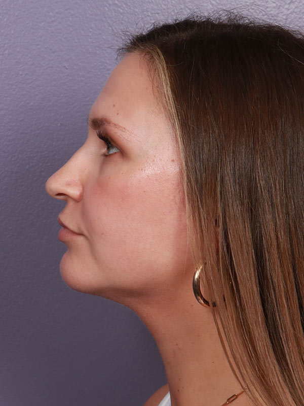 Neck Lift Before & After Image