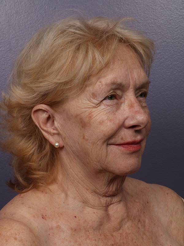 Neck Lift Before & After Image