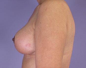 Nipple - Areola Correction Before & After Image