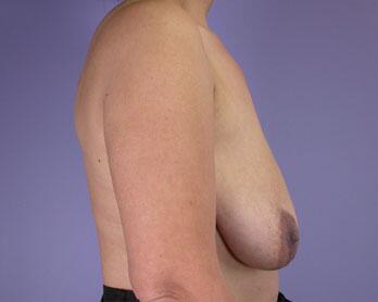 Nipple - Areola Correction Before & After Image