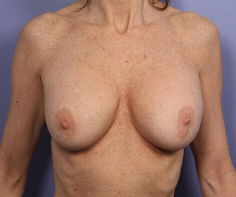 Nipple - Areola Correction Before & After Image