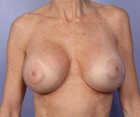 Nipple - Areola Correction Before & After Image