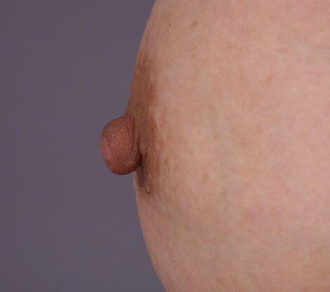 Nipple - Areola Correction Before & After Image