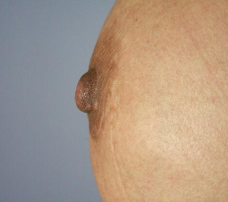 Nipple - Areola Correction Before & After Image