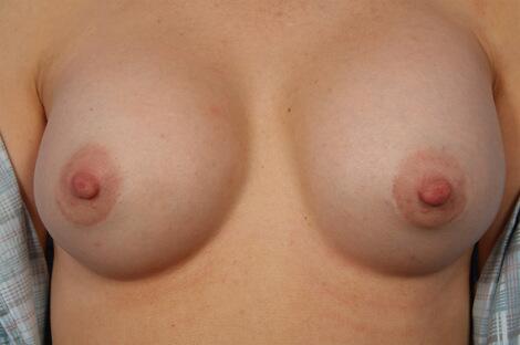 Nipple - Areola Correction Before & After Image