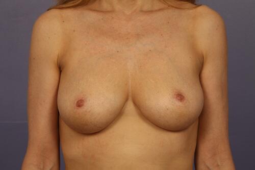 Nipple - Inversion Correction Before & After Image