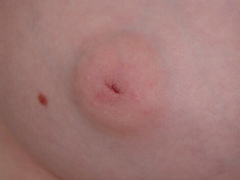 Nipple - Inversion Correction Before & After Image