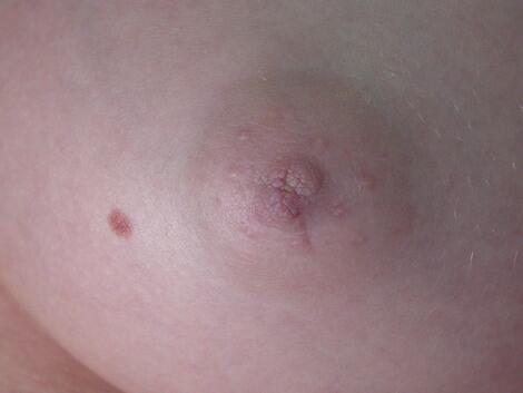 Nipple - Inversion Correction Before & After Image