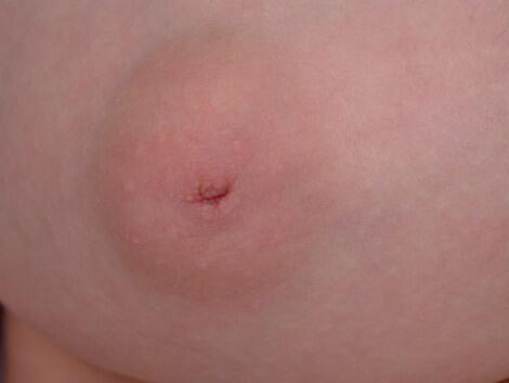 Nipple - Inversion Correction Before & After Image