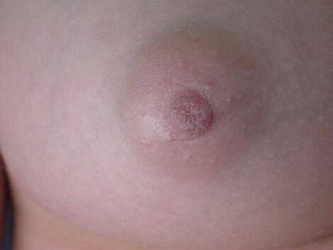 Nipple - Inversion Correction Before & After Image