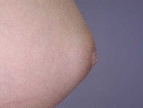 Nipple - Inversion Correction Before & After Image