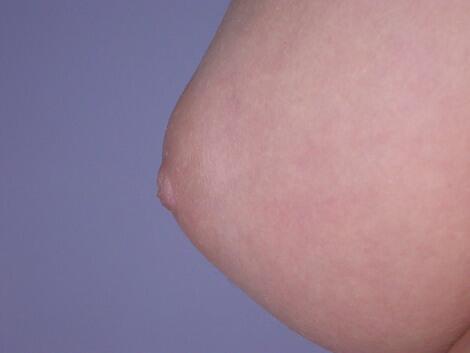 Nipple - Inversion Correction Before & After Image