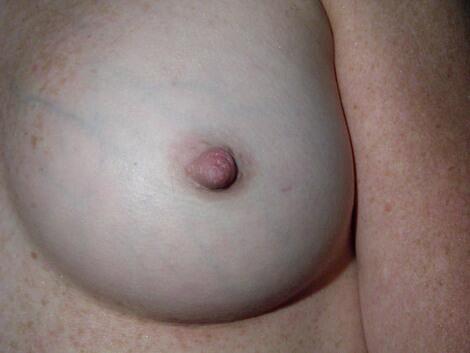 Nipple - Inversion Correction Before & After Image