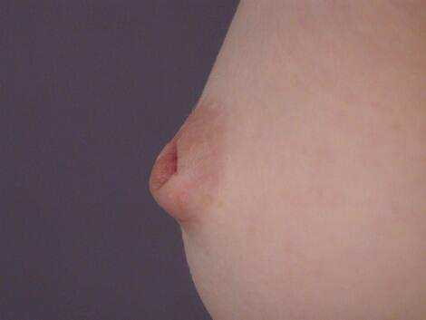 Nipple - Inversion Correction Before & After Image