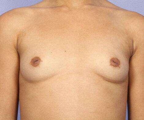 Nipple - Inversion Correction Before & After Image