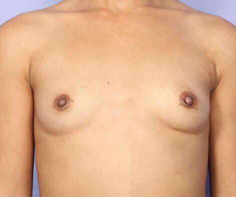 Nipple - Inversion Correction Before & After Image