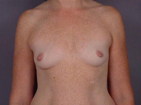 Nipple - Inversion Correction Before & After Image