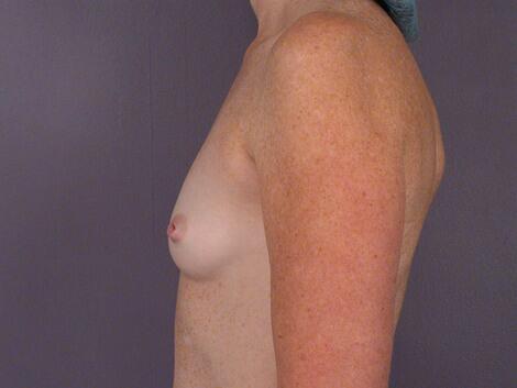 Nipple - Inversion Correction Before & After Image