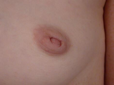 Nipple - Inversion Correction Before & After Image