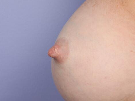 Nipple - Inversion Correction Before & After Image